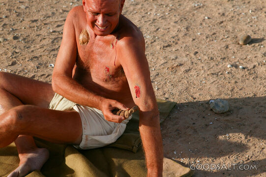Leper Scratching Soar With a Stone
