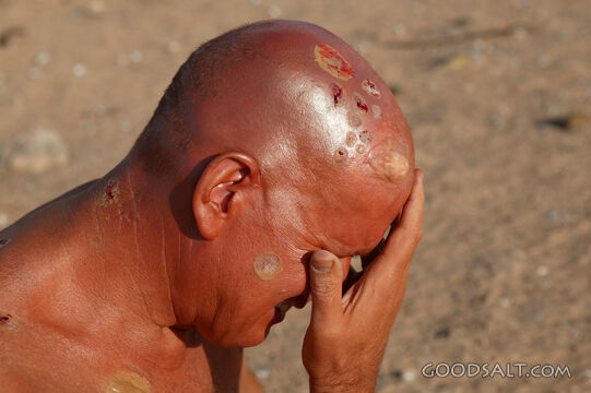 Leper With Head Bowed